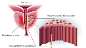 prostatit - mualicesi Bakida -androloq Ziyad dr- prostat vezi kalsinat xroniki prostatit uzman uroloq dr ziyad 